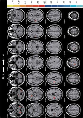 Alterations of Regional Homogeneity in the Mild and Moderate Stages of Parkinson’s Disease